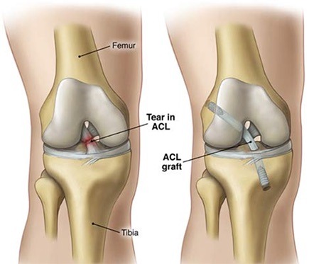 Often triggered by young people playing sports, nearly 200,000 people tear their ACL each year. Simulation of the movement and internal loading of the knee lends guidance to positioning the graft at angles that will optimize recovery and reduce future complications. From Wooster Orthopaedic & Sports Medicine Center
