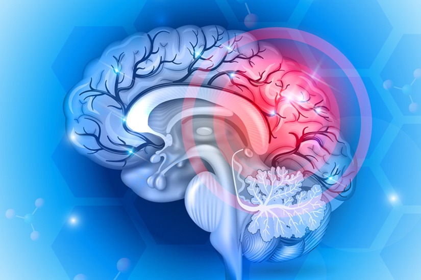 Image of brain concussion