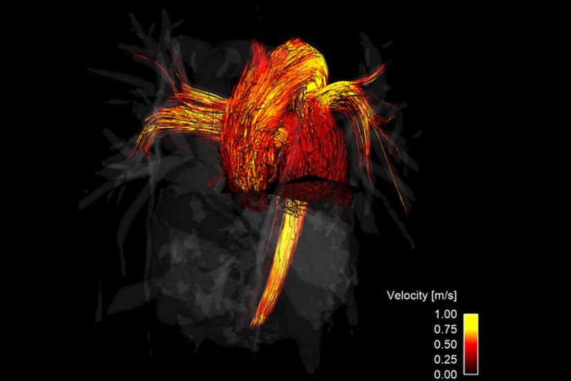 Image of blood flow MRI