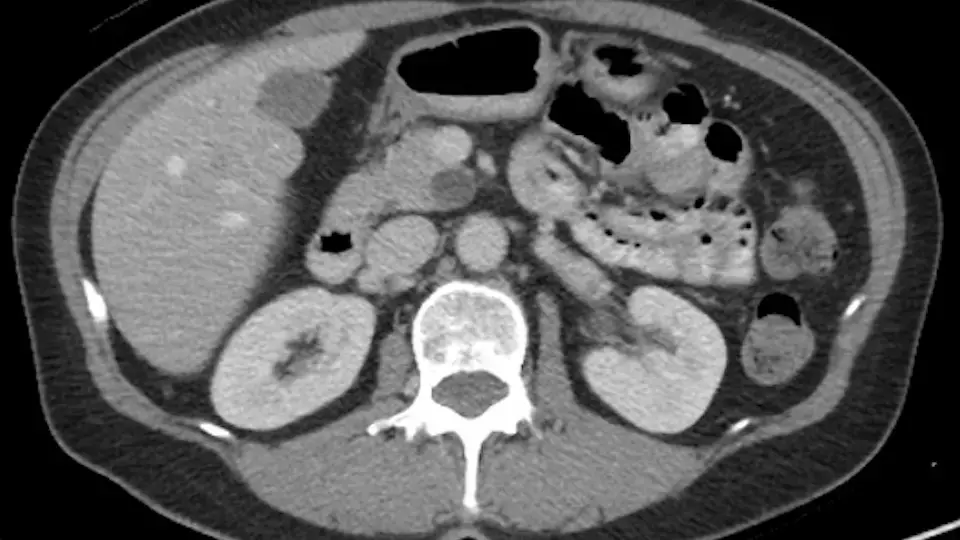 pancreatic cyst CT image
